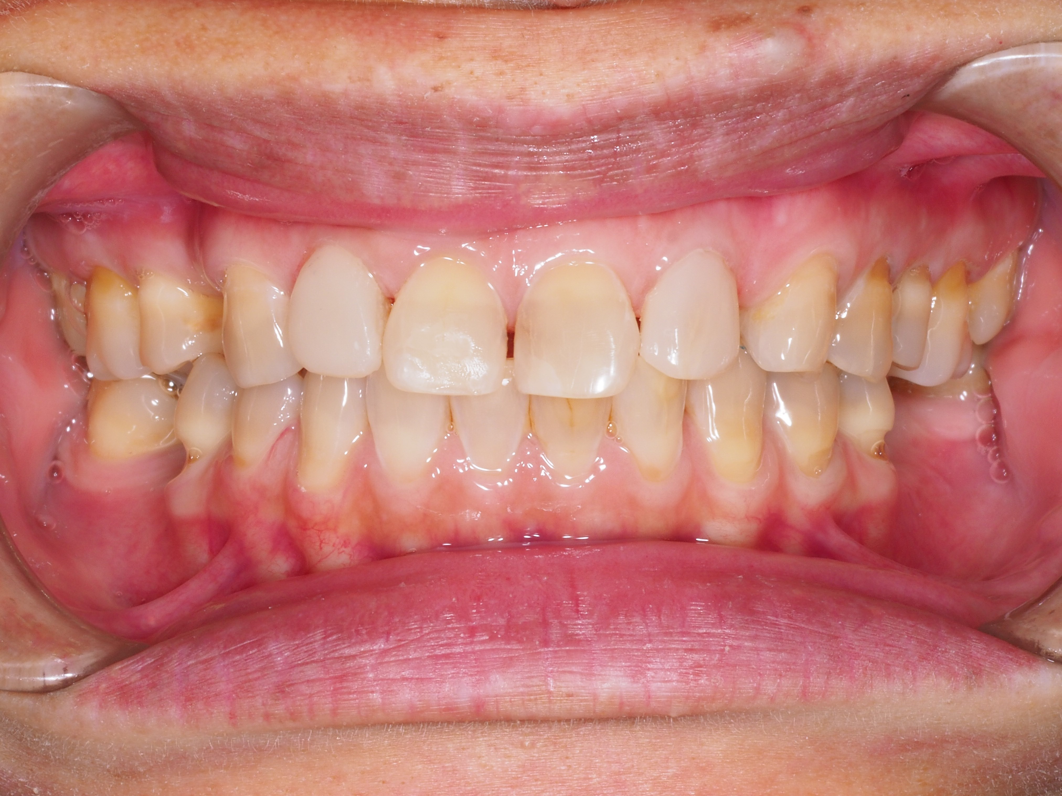 After Invisalign